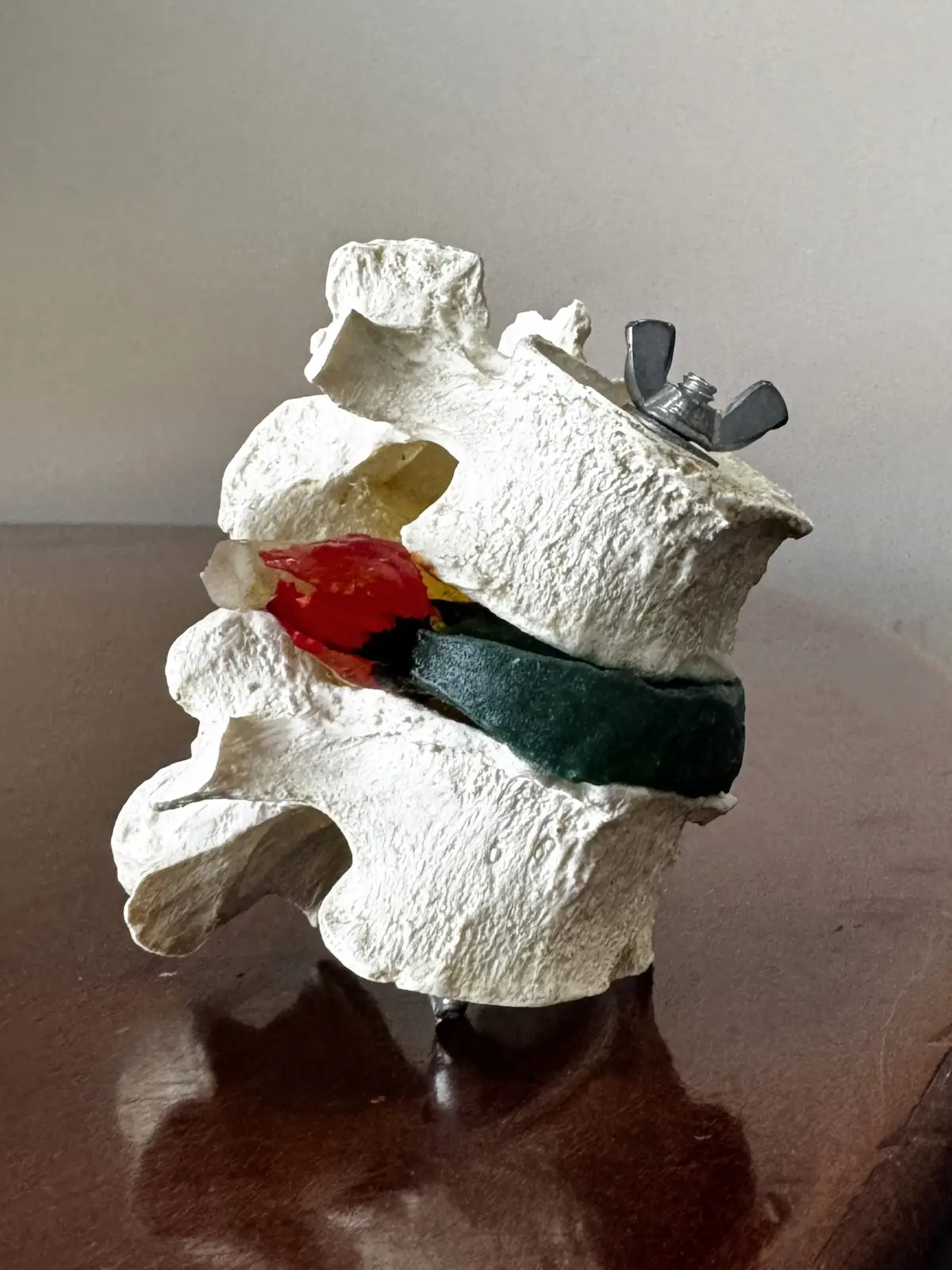 A medical model of two white spinal vertebrae with a green disc and a red herniated disc, held together by a wing nut, on a reflective surface.